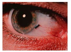 Dị vật trong giác mạc - Hình ảnh minh họa